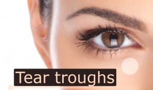 Tear Troughs